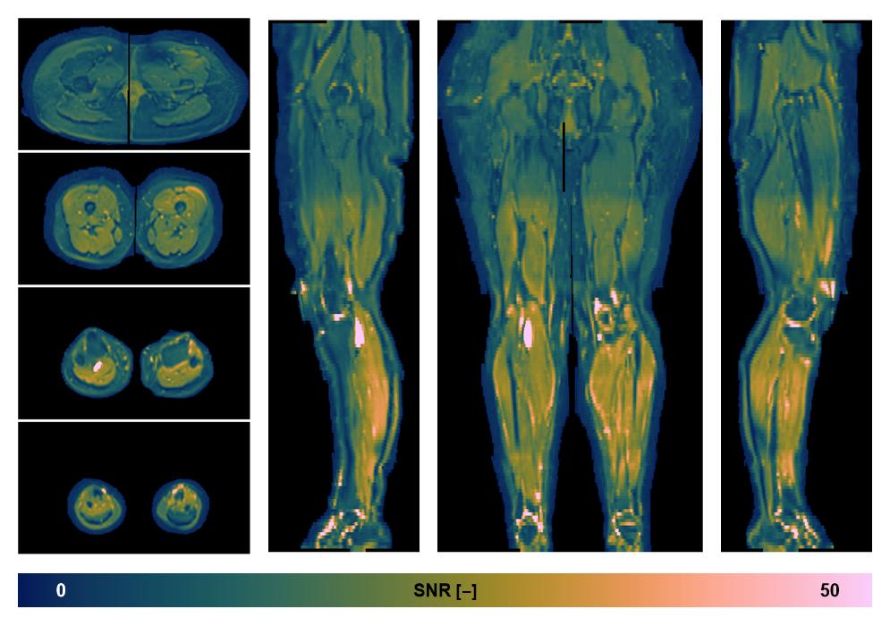 SNR distribution of the unweighted diffusion data.