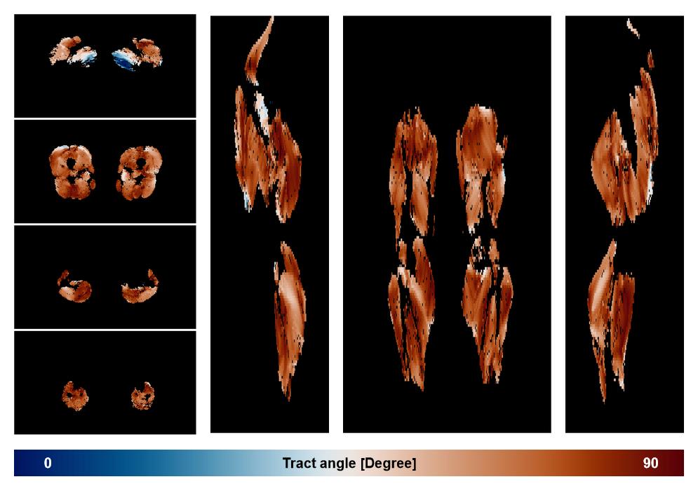 Muscle fiber tract angle map based on whole leg DTI based fiber tractography.