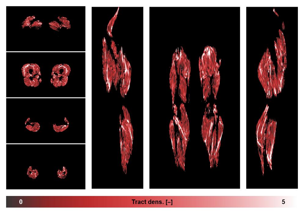 Muscle fiber tract density map based on whole leg DTI based fiber tractography.