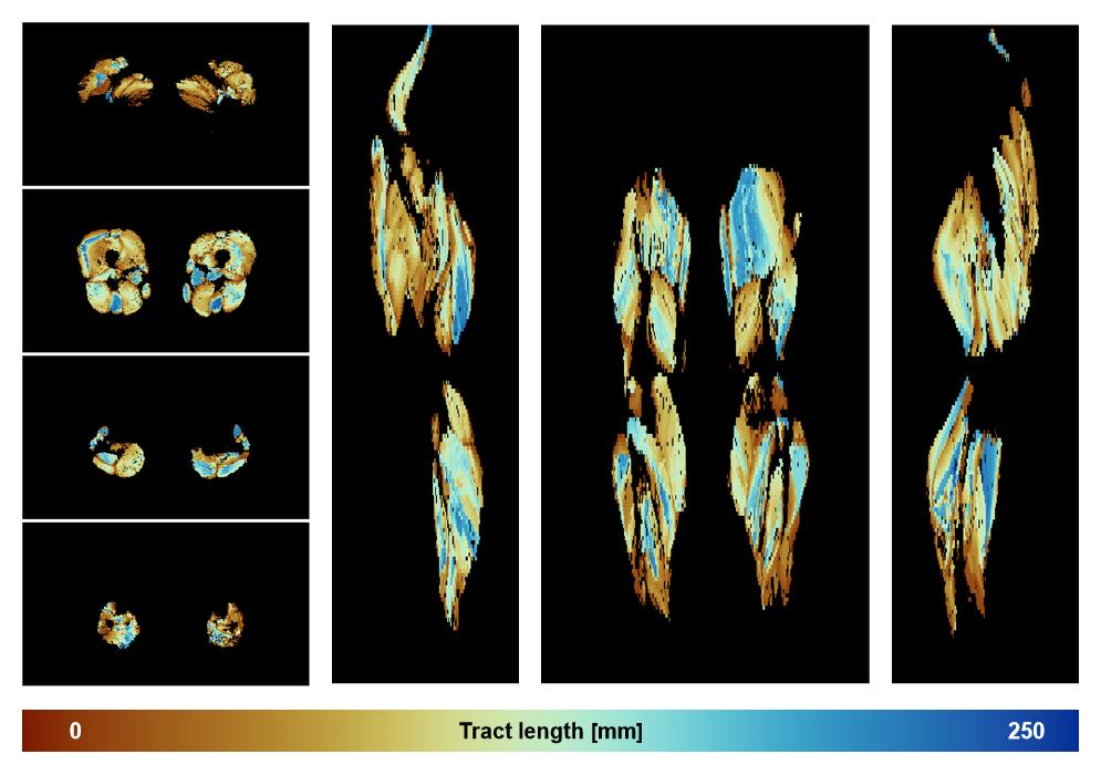 Muscle fiber tract length map based on whole leg DTI based fiber tractography.