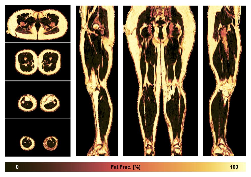 The fat fraction of the lower extremity obtained from the dixon reconstruction for muscle water fat quantification.