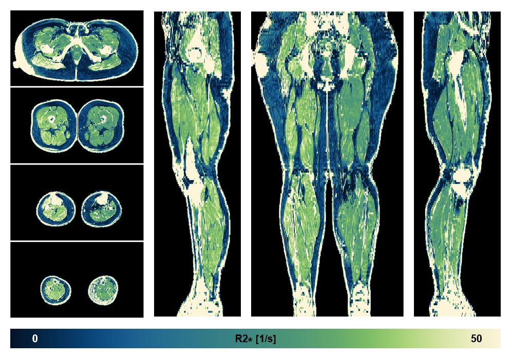 The R2 star relaxation time of the lower extremity obtained from the dixon reconstruction for muscle water fat quantification.