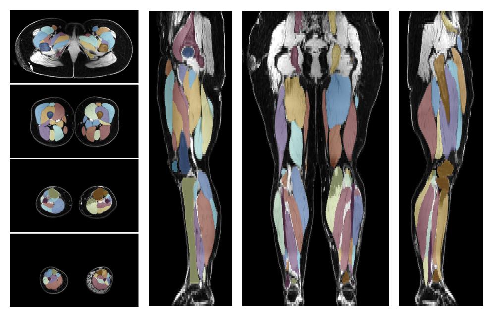 Overlay of automated muscle segmentation labels on dixon water image.