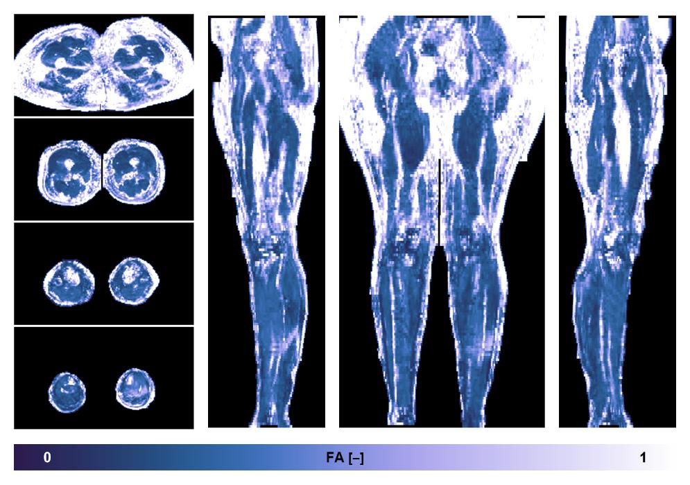 IVIM corrected whole leg muscle fractional anisotropy obtained from diffusion tensor imaging.