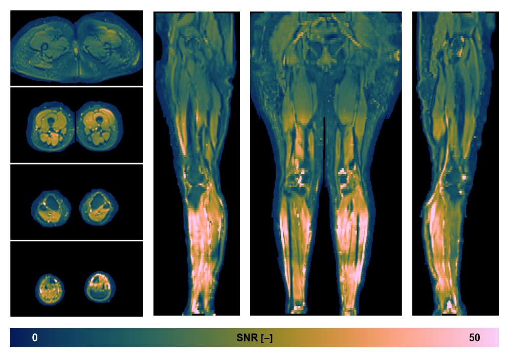 SNR distribution of the unweighted diffusion data.
