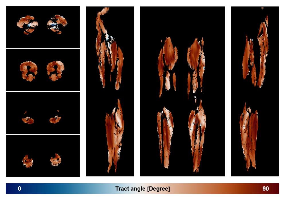 Muscle fiber tract angle map based on whole leg DTI based fiber tractography.