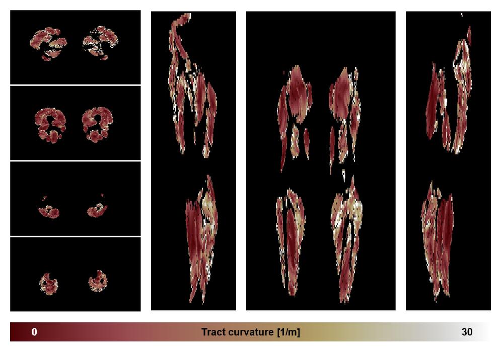 Muscle fiber tract curvature map based on whole leg DTI based fiber tractography.