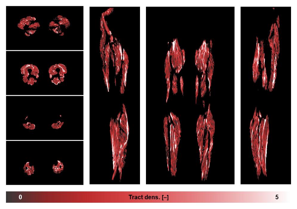 Muscle fiber tract density map based on whole leg DTI based fiber tractography.