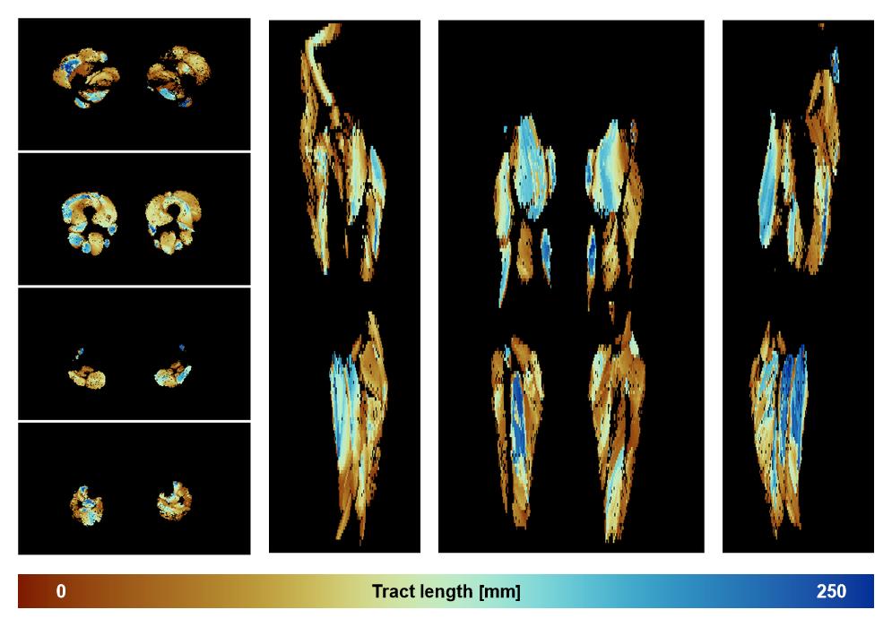 Muscle fiber tract length map based on whole leg DTI based fiber tractography.