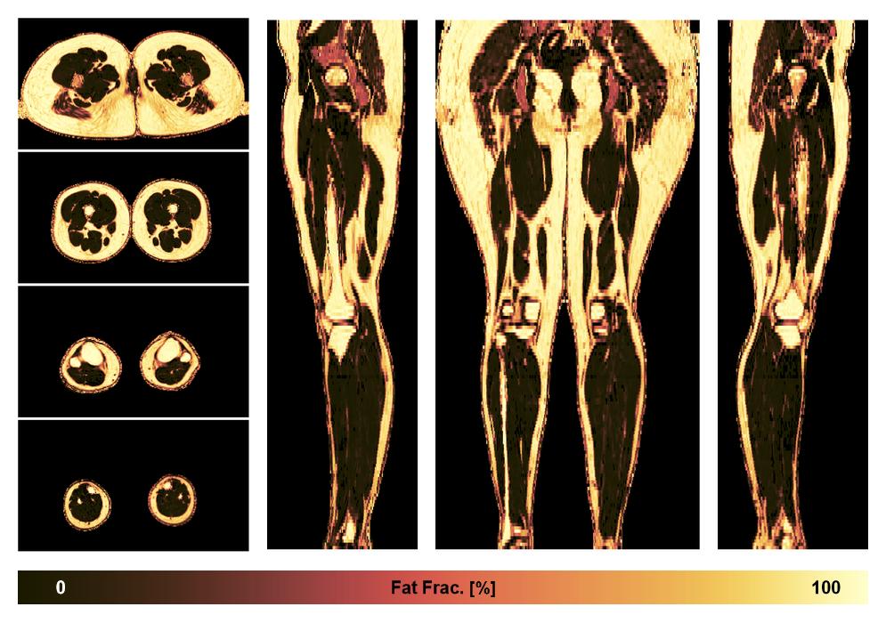 The fat fraction of the lower extremity obtained from the dixon reconstruction for muscle water fat quantification.