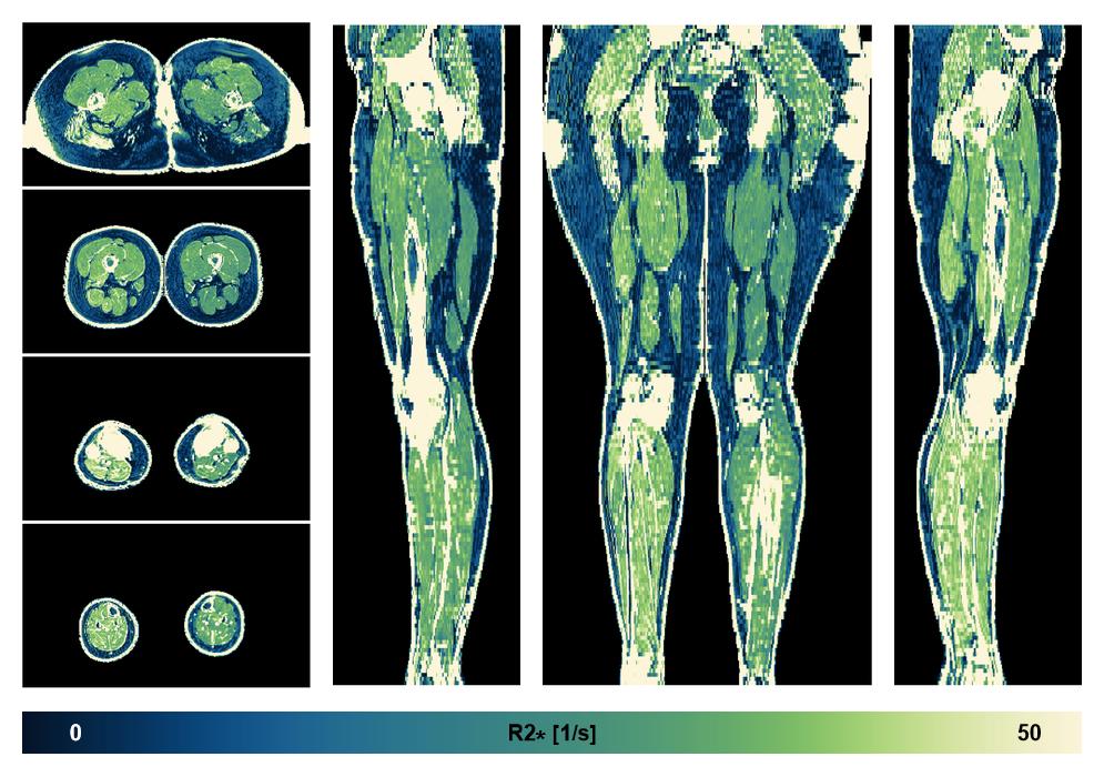 The R2 star relaxation time of the lower extremity obtained from the dixon reconstruction for muscle water fat quantification.