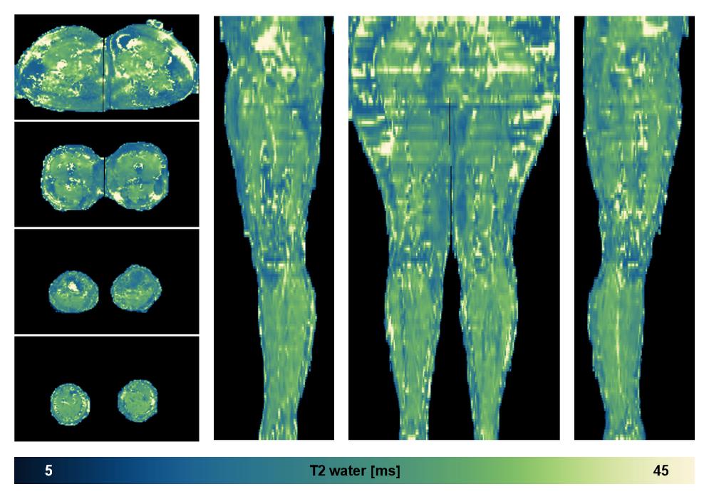 The water only T2 relaxation time of the lower extremity obtained from multi echo spin echo t2 mapping with EPG based reconstruction.
