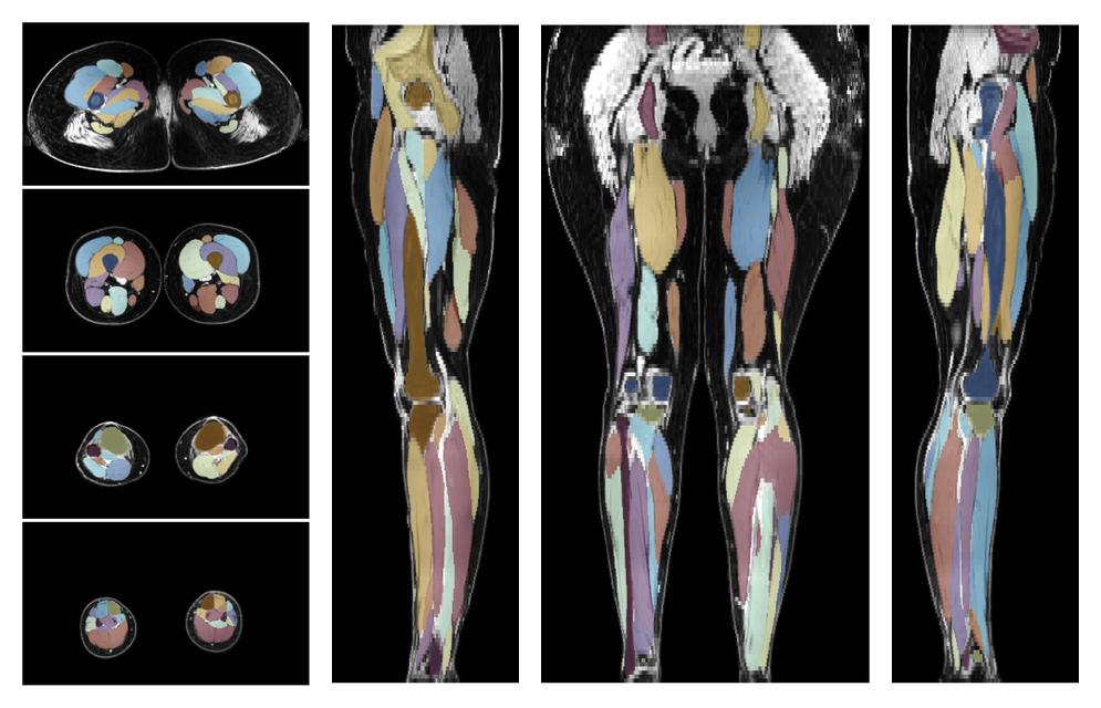Overlay of automated muscle segmentation labels on dixon water image.