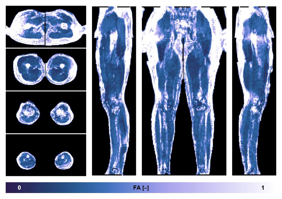 IVIM corrected whole leg muscle fractional anisotropy obtained from diffusion tensor imaging.