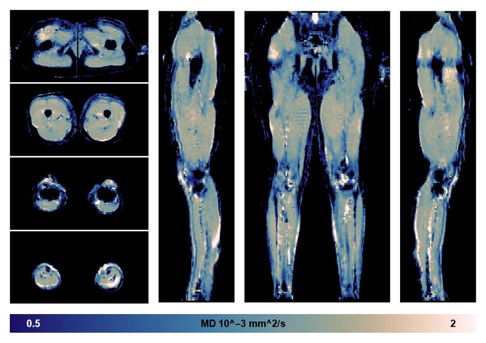 IVIM corrected whole leg muscle mean diffusivity obtained from diffusion tensor imaging.