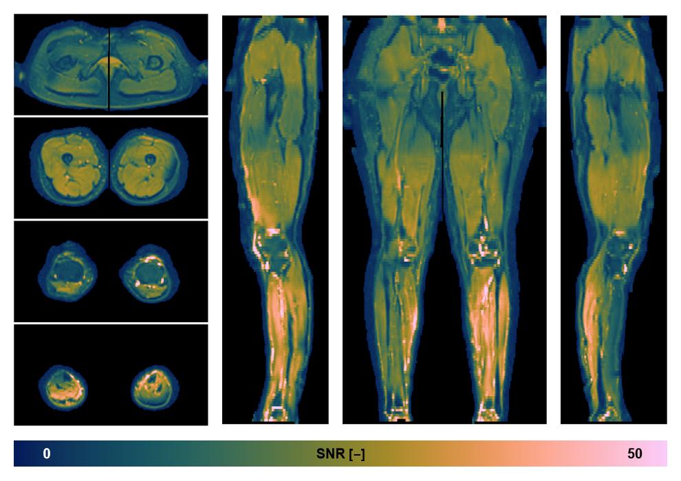 SNR distribution of the unweighted diffusion data.