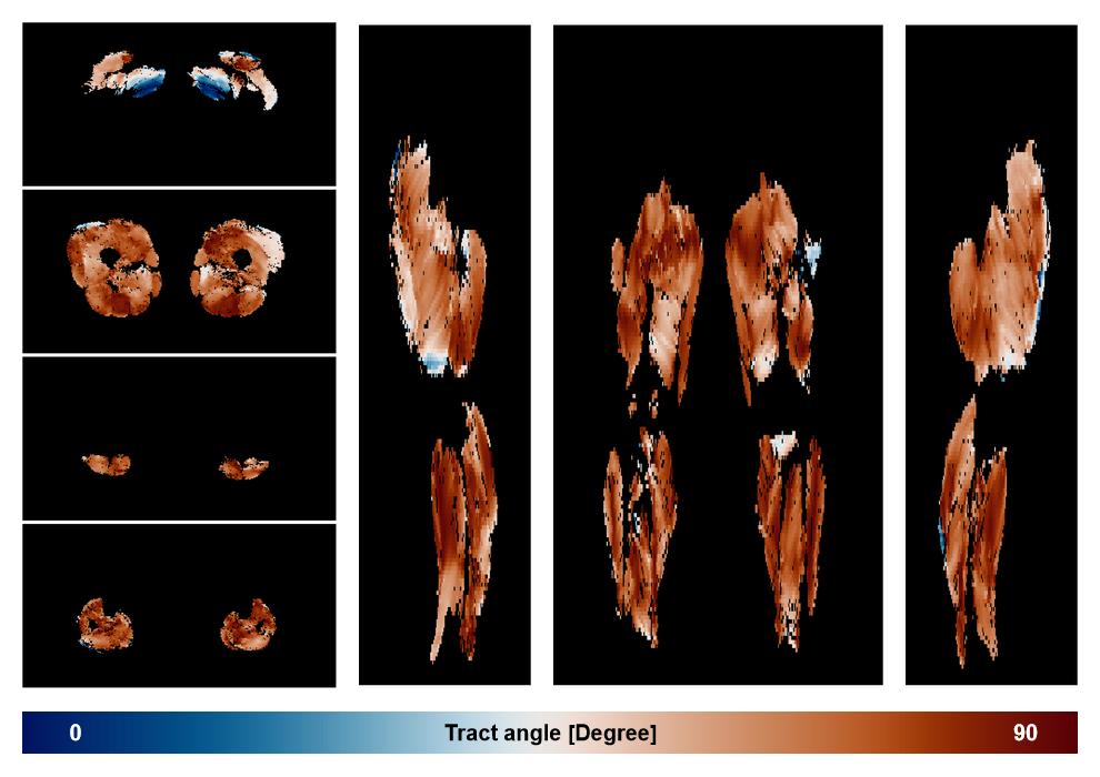 Muscle fiber tract angle map based on whole leg DTI based fiber tractography.