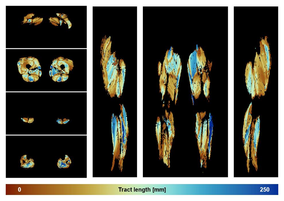 Muscle fiber tract length map based on whole leg DTI based fiber tractography.