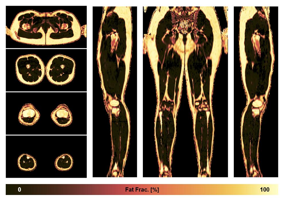 The fat fraction of the lower extremity obtained from the dixon reconstruction for muscle water fat quantification.