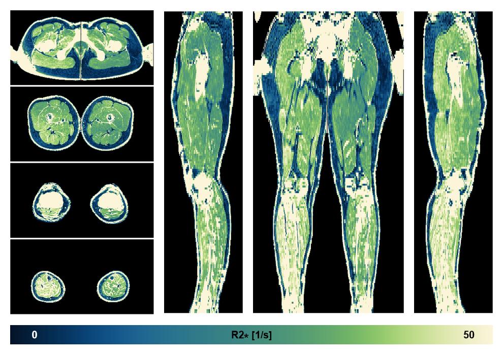 The R2 star relaxation time of the lower extremity obtained from the dixon reconstruction for muscle water fat quantification.