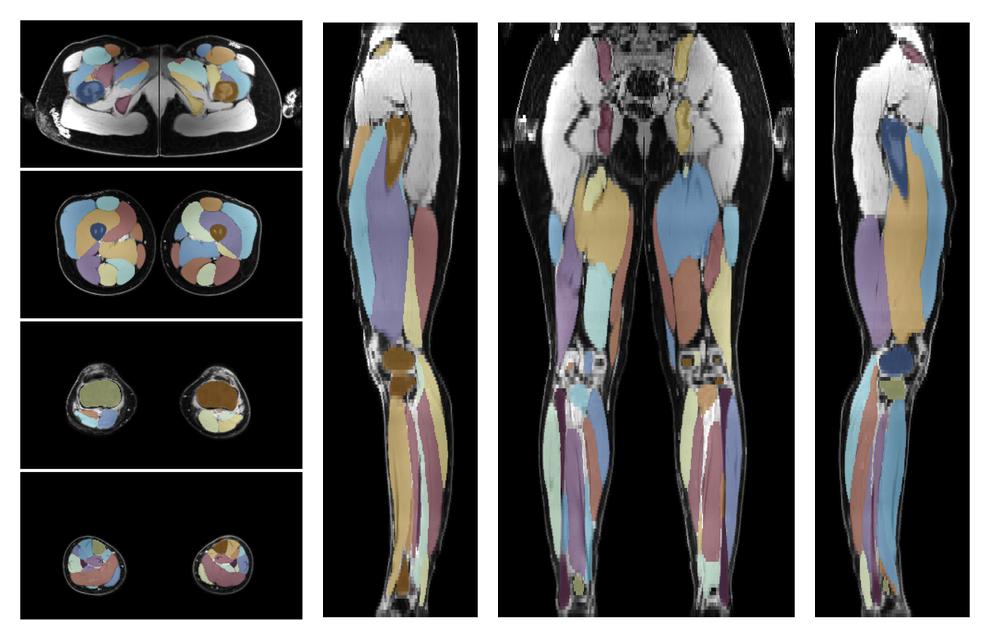 Overlay of automated muscle segmentation labels on dixon water image.