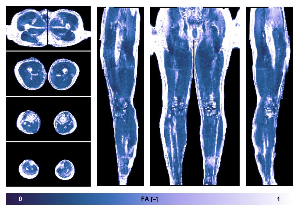 IVIM corrected whole leg muscle fractional anisotropy obtained from diffusion tensor imaging.