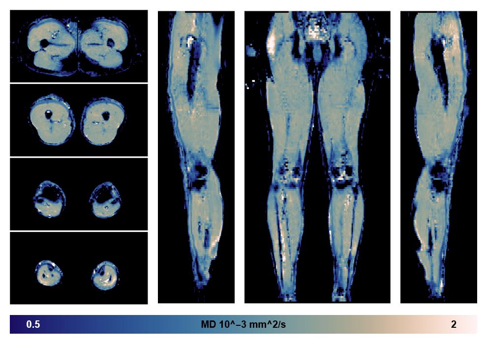 IVIM corrected whole leg muscle mean diffusivity obtained from diffusion tensor imaging.
