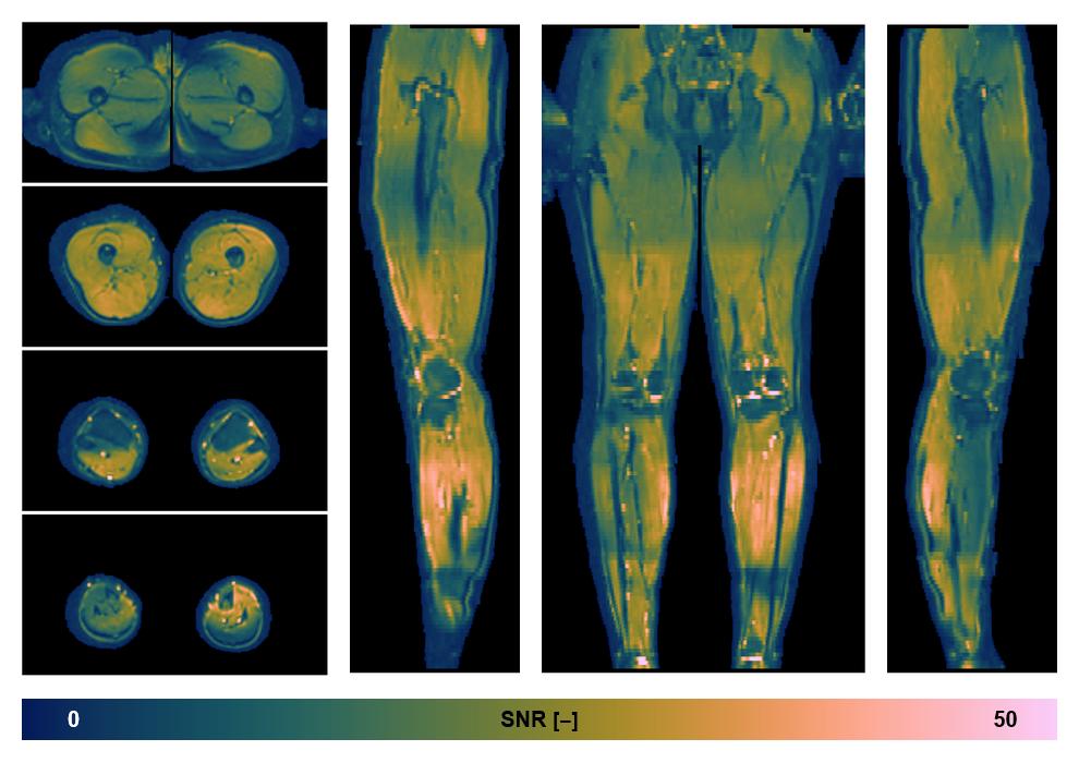 SNR distribution of the unweighted diffusion data.