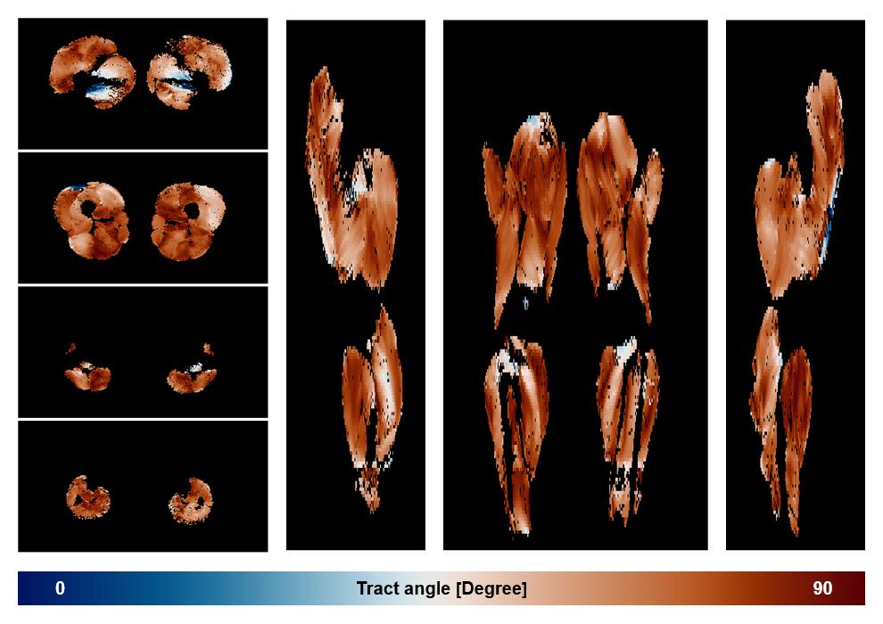 Muscle fiber tract angle map based on whole leg DTI based fiber tractography.