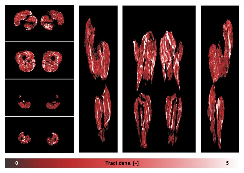 Muscle fiber tract density map based on whole leg DTI based fiber tractography.