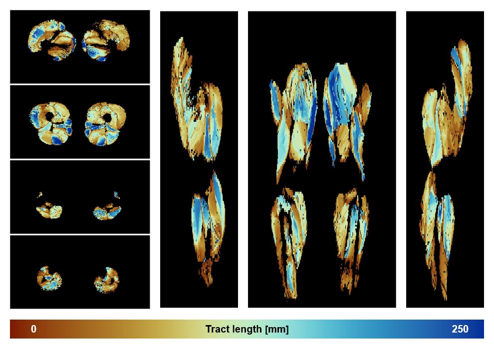 Muscle fiber tract length map based on whole leg DTI based fiber tractography.