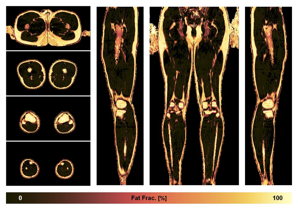 The fat fraction of the lower extremity obtained from the dixon reconstruction for muscle water fat quantification.
