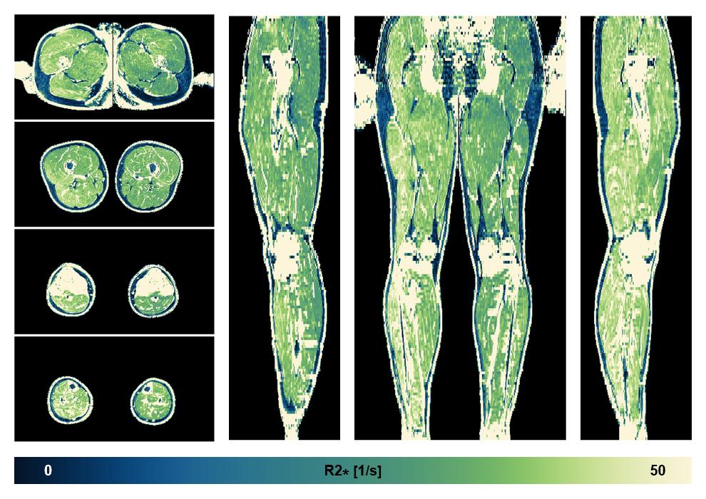 The R2 star relaxation time of the lower extremity obtained from the dixon reconstruction for muscle water fat quantification.