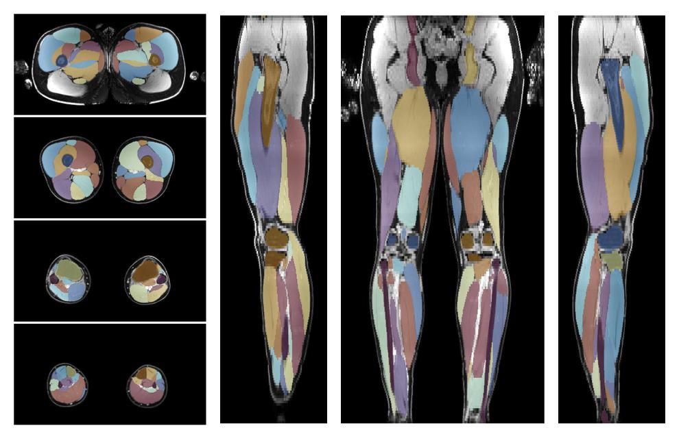 Overlay of automated muscle segmentation labels on dixon water image.
