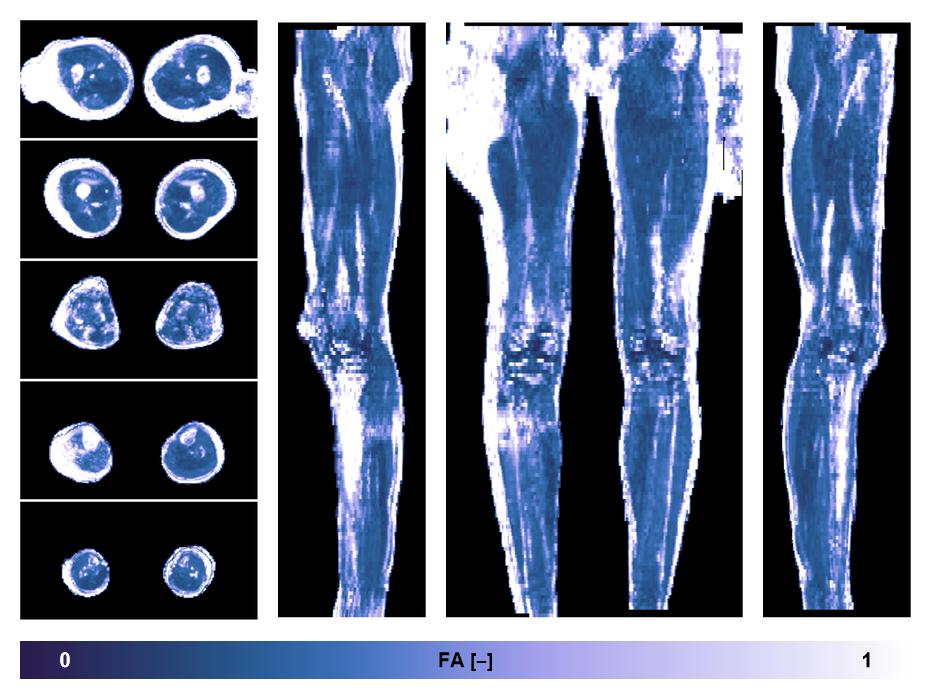 IVIM corrected whole leg muscle fractional anisotropy obtained from diffusion tensor imaging.