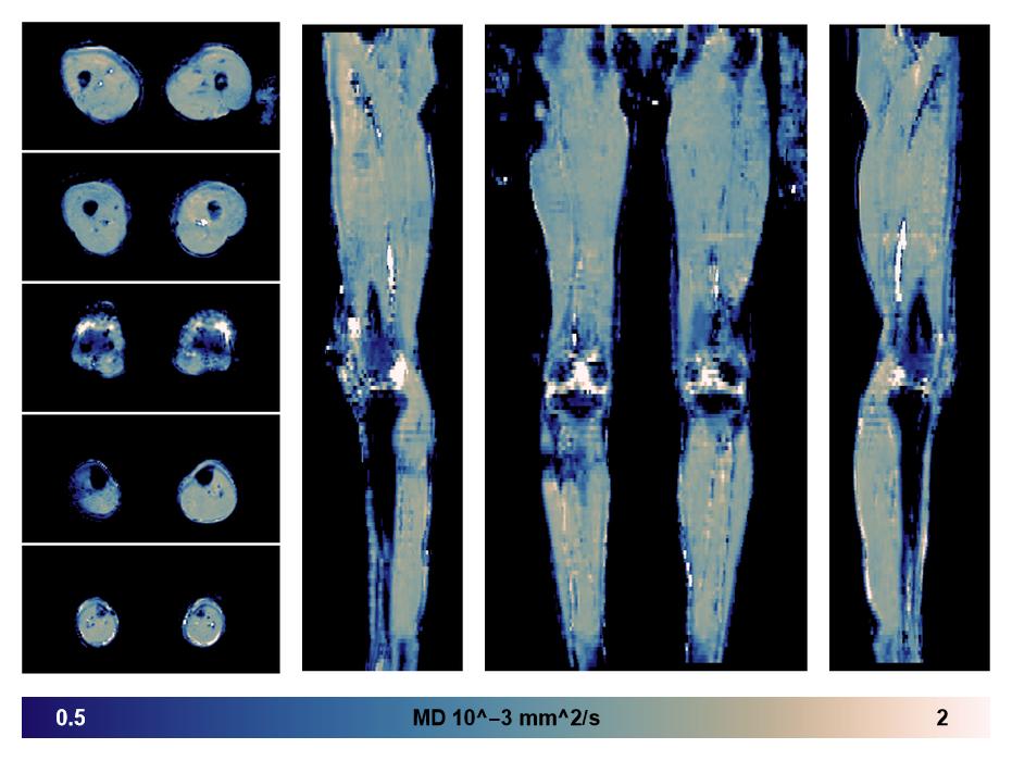 IVIM corrected whole leg muscle mean diffusivity obtained from diffusion tensor imaging.