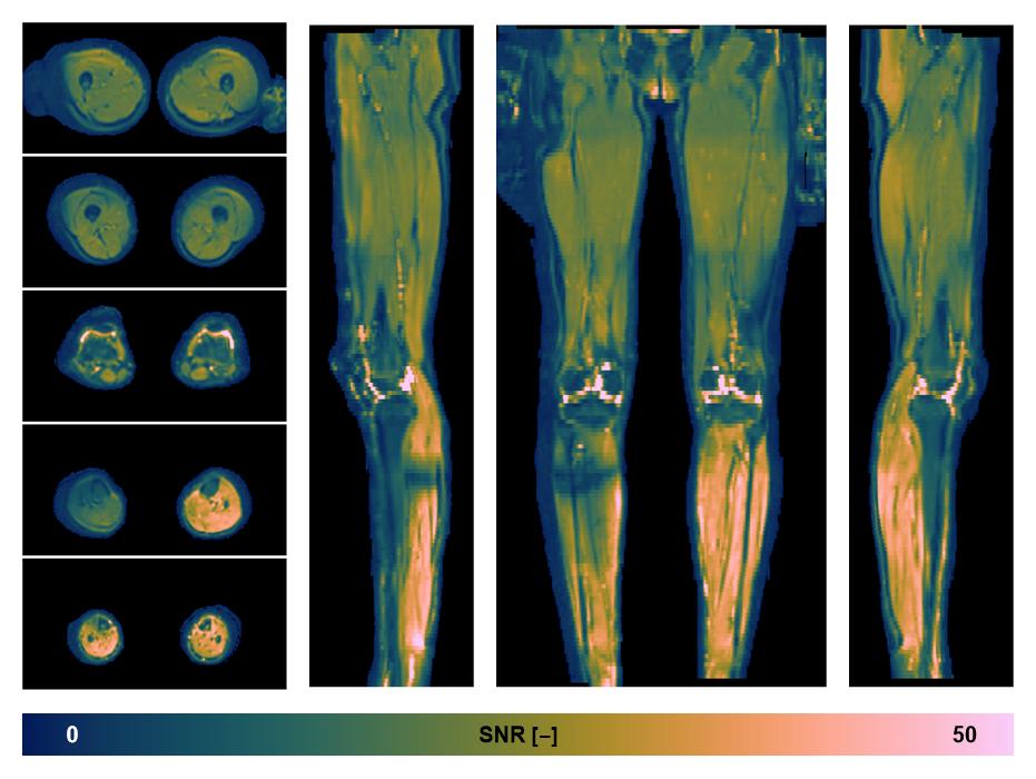 SNR distribution of the unweighted diffusion data.
