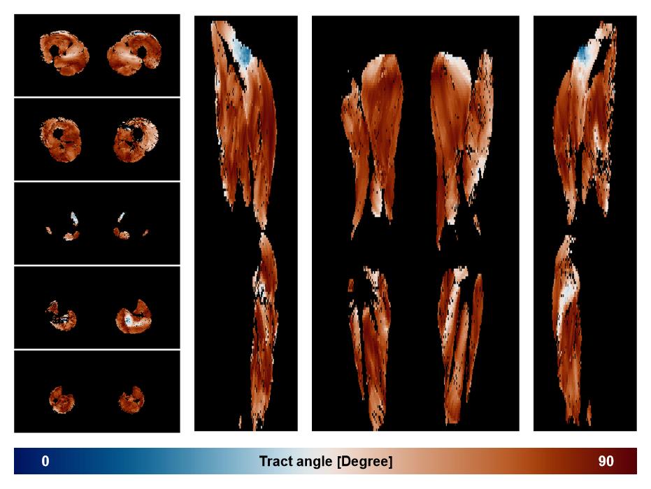Muscle fiber tract angle map based on whole leg DTI based fiber tractography.