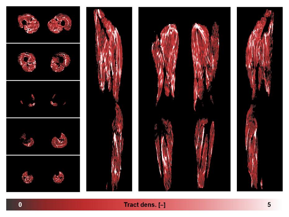 Muscle fiber tract density map based on whole leg DTI based fiber tractography.