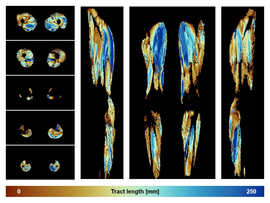 Muscle fiber tract length map based on whole leg DTI based fiber tractography.
