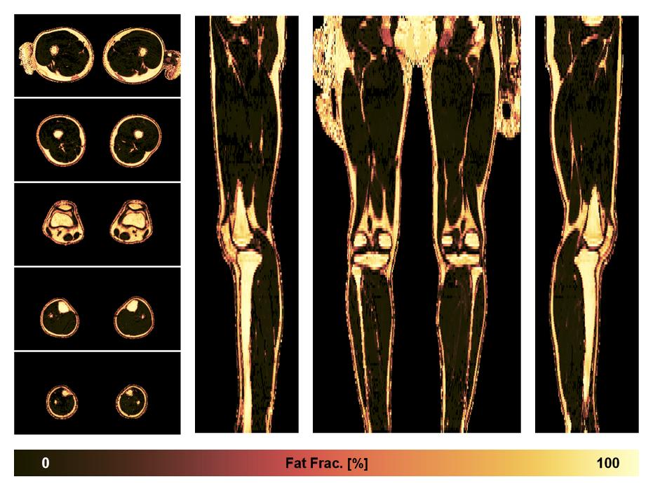 The fat fraction of the lower extremity obtained from the dixon reconstruction for muscle water fat quantification.