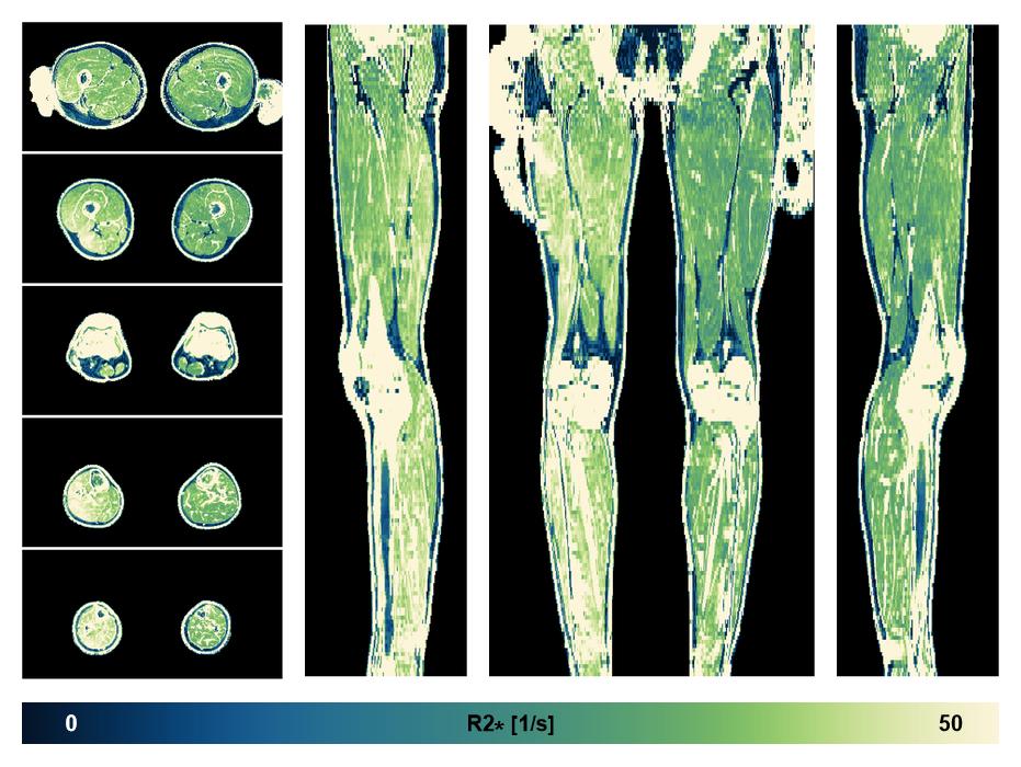 The R2 star relaxation time of the lower extremity obtained from the dixon reconstruction for muscle water fat quantification.