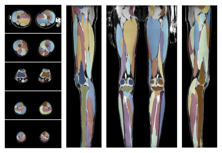 Overlay of automated muscle segmentation labels on dixon water image.