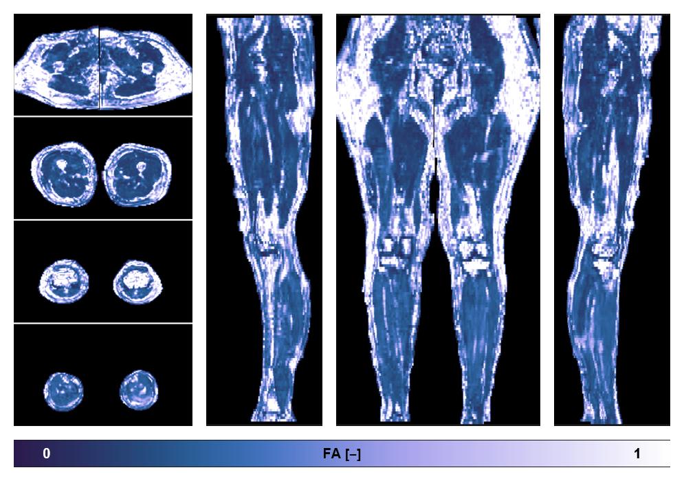 IVIM corrected whole leg muscle fractional anisotropy obtained from diffusion tensor imaging.