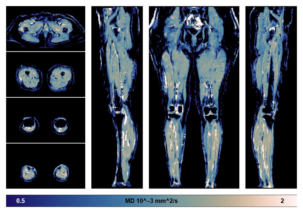 IVIM corrected whole leg muscle mean diffusivity obtained from diffusion tensor imaging.