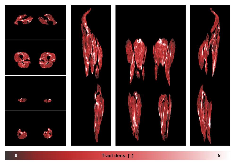 Muscle fiber tract density map based on whole leg DTI based fiber tractography.