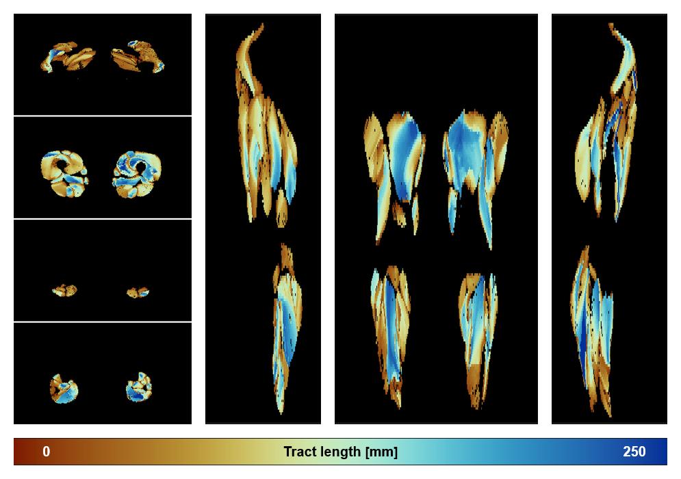 Muscle fiber tract length map based on whole leg DTI based fiber tractography.