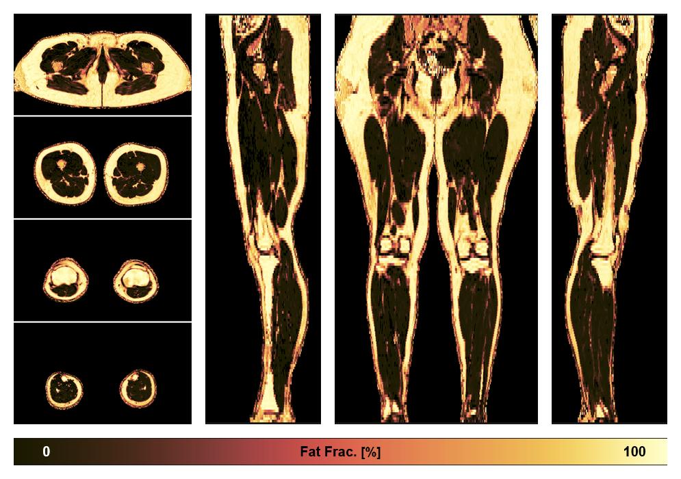 The fat fraction of the lower extremity obtained from the dixon reconstruction for muscle water fat quantification.