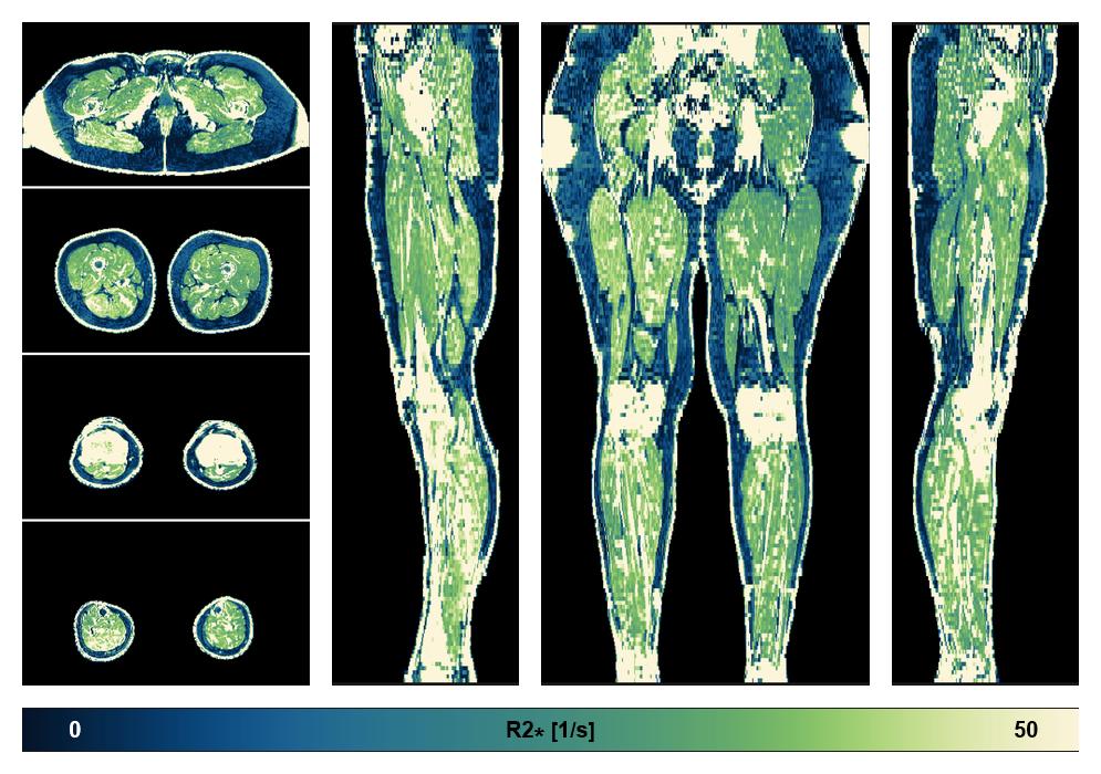 The R2 star relaxation time of the lower extremity obtained from the dixon reconstruction for muscle water fat quantification.