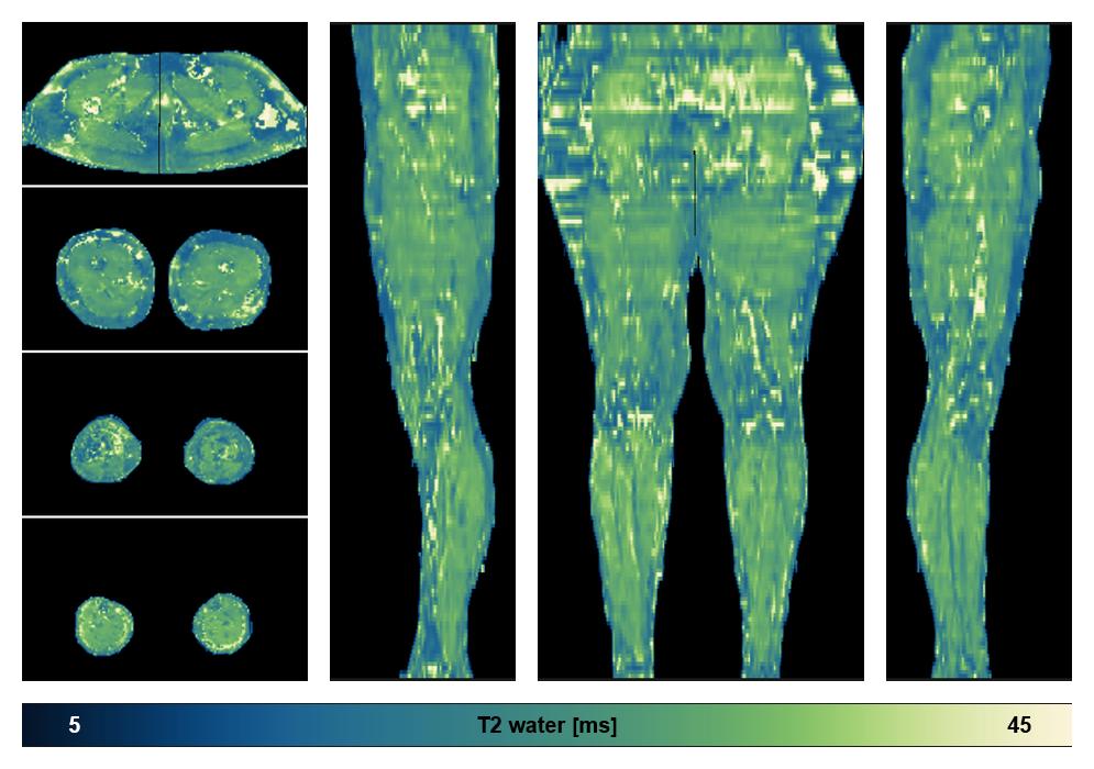 The water only T2 relaxation time of the lower extremity obtained from multi echo spin echo t2 mapping with EPG based reconstruction.